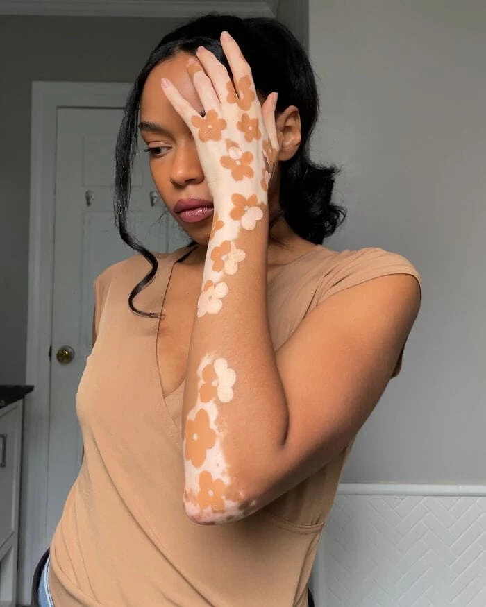 amara-aleman-vitiligo-art-peinture-bodypositive-tiktok-inspiration-1
