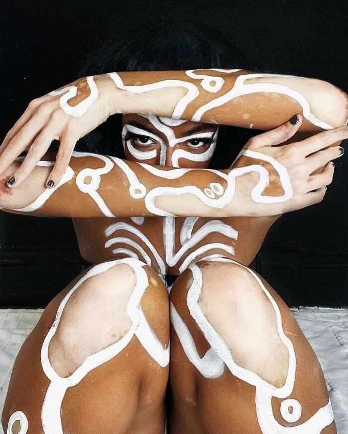 amara-aleman-vitiligo-art-peinture-bodypositive